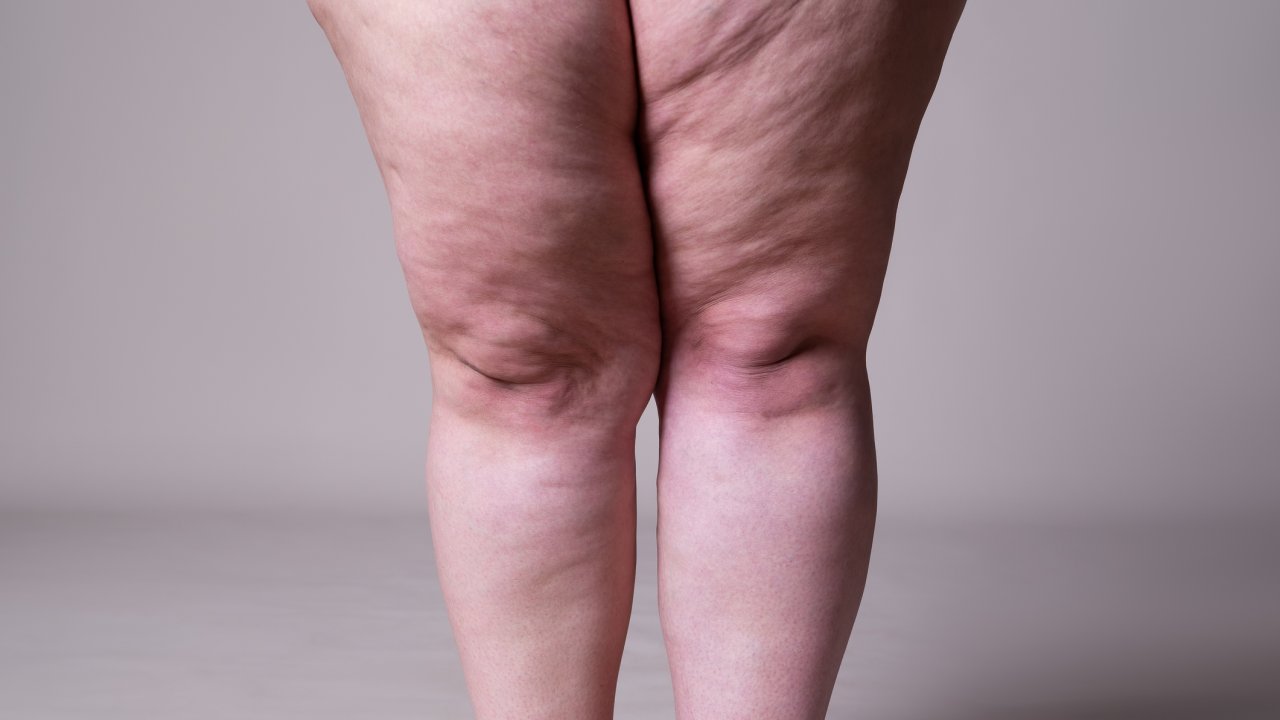 lipedema-alimentacao