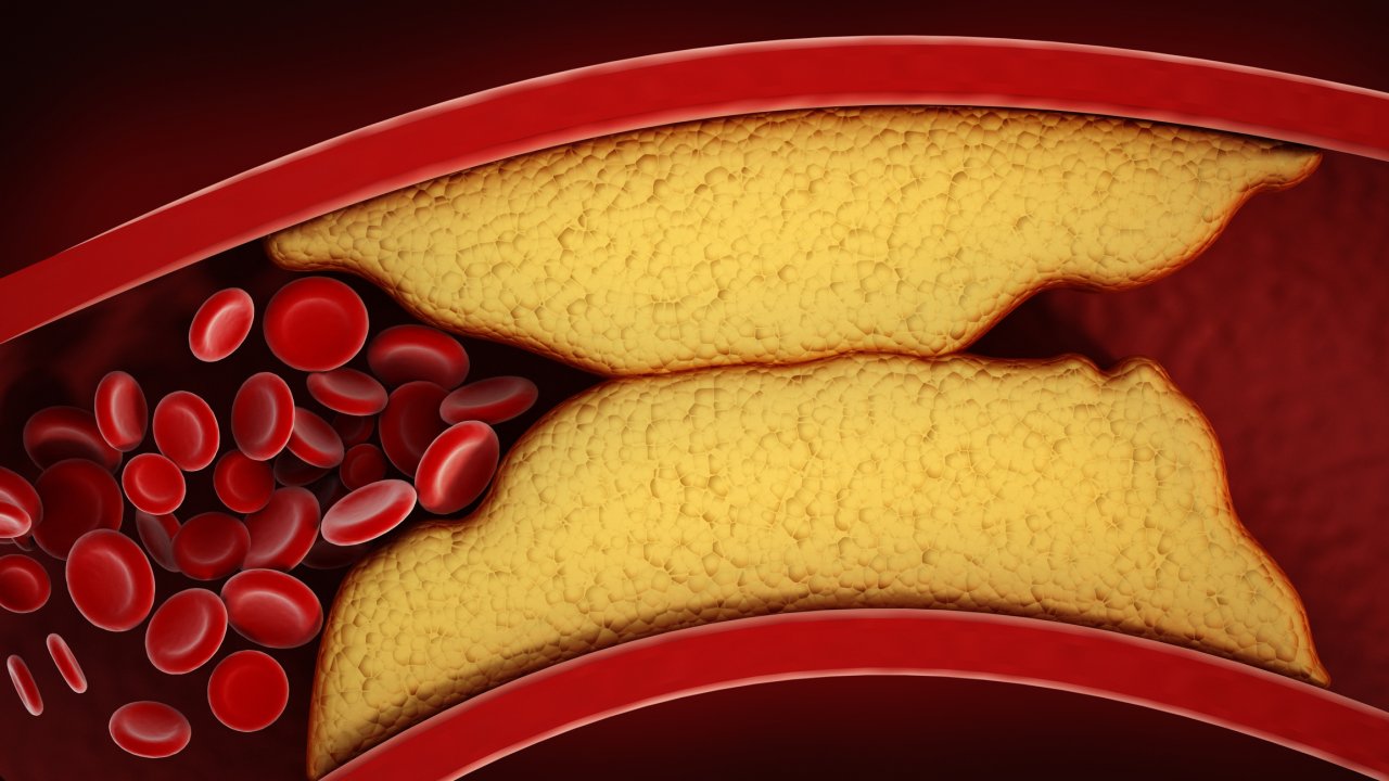 colesterol-gordura-arteria