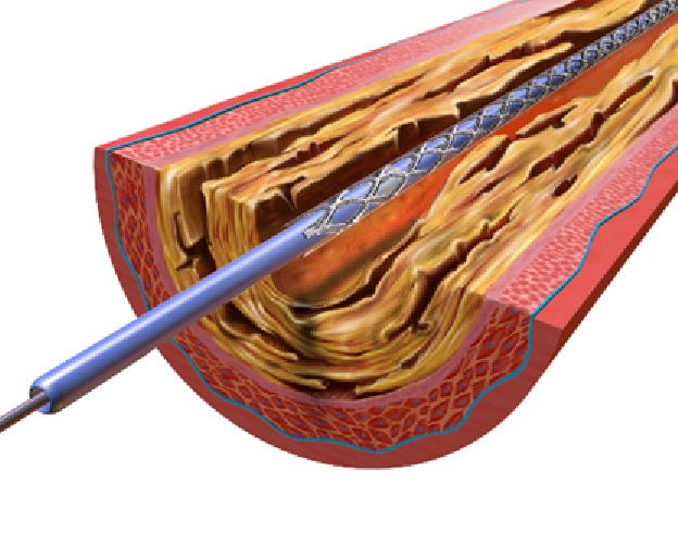angioplastia-tratamento-stents