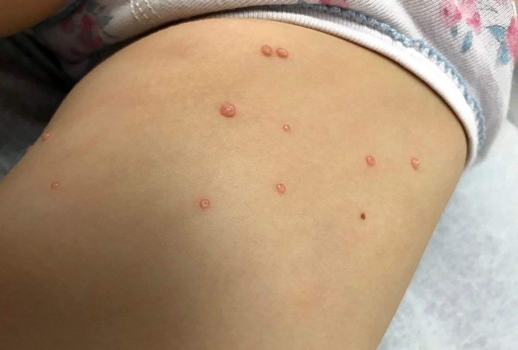 molusco-contagioso-doenca-pele