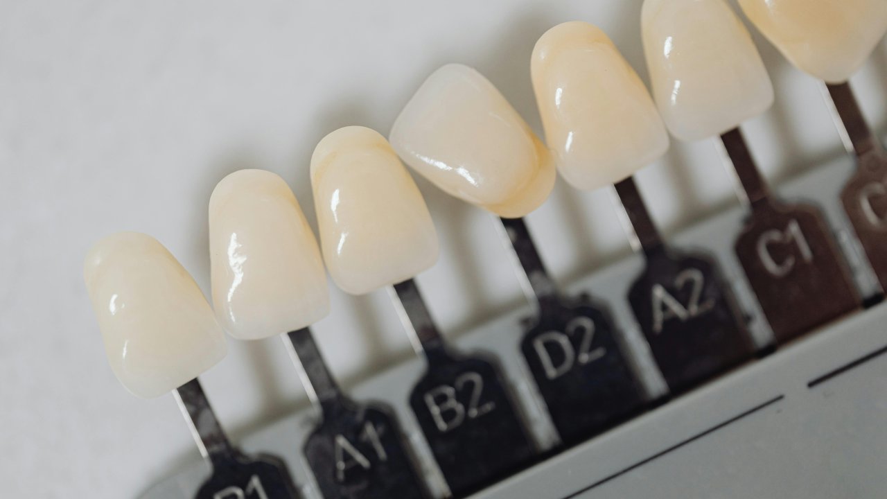 faceta-dentes-materiais-2