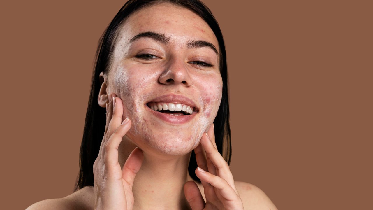 purging-acne-skincare-reacao