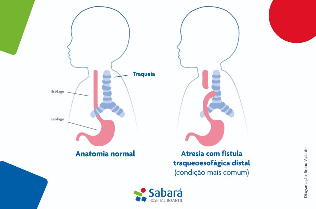 atresia-do-esofago-fistula