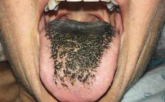 Língua pilosa: entenda o problema que deixa a língua preta e “peluda”