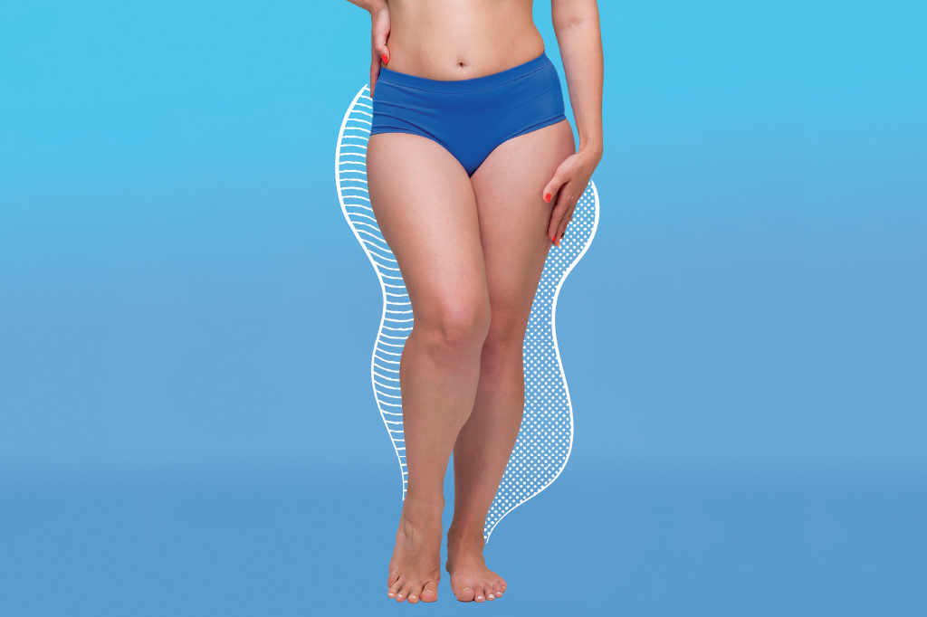 Celulite ou lipedema? Como diferenciar antes de se autodiagnosticar