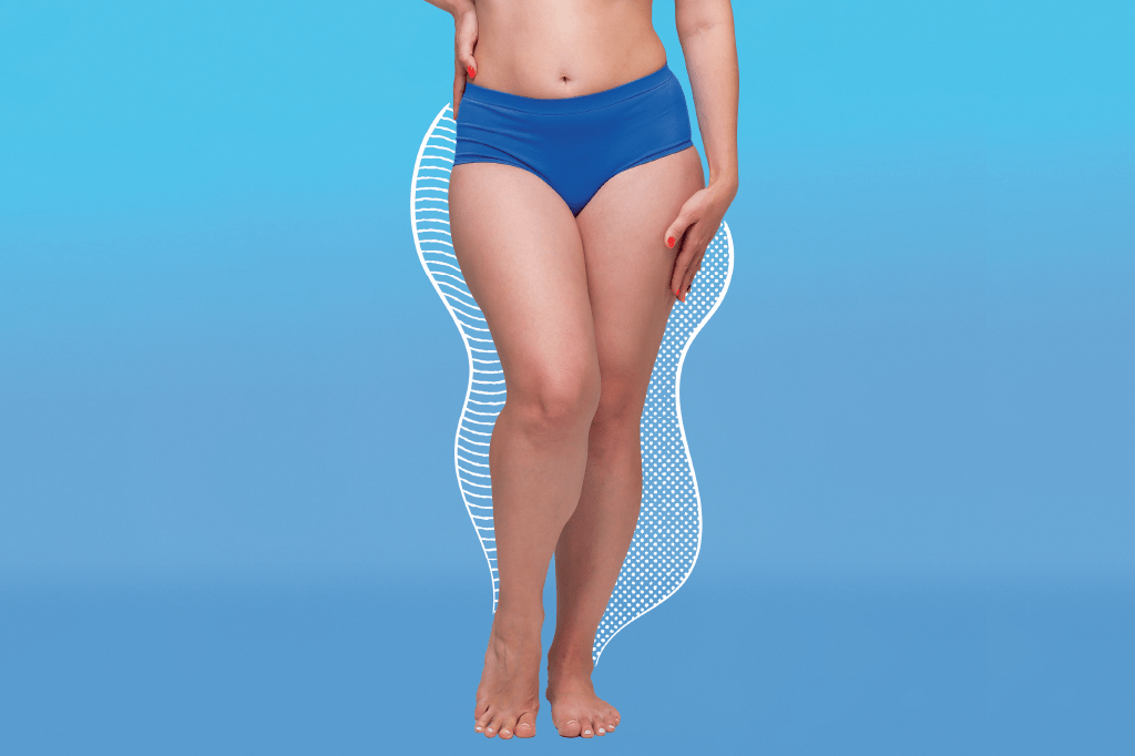 Lipedema: reduzir o consumo de carboidratos pode aliviar a dor