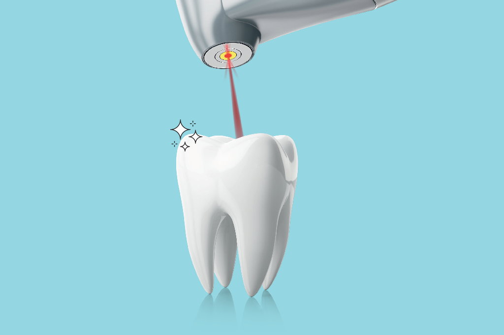 Esqueça o barulho do motorzinho! Limpeza bucal a laser e sem dor é possível