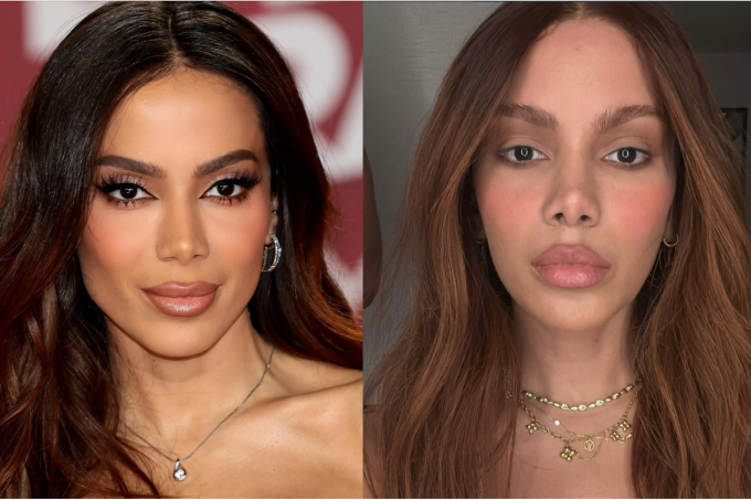 Anitta-lifting-novo-rosto