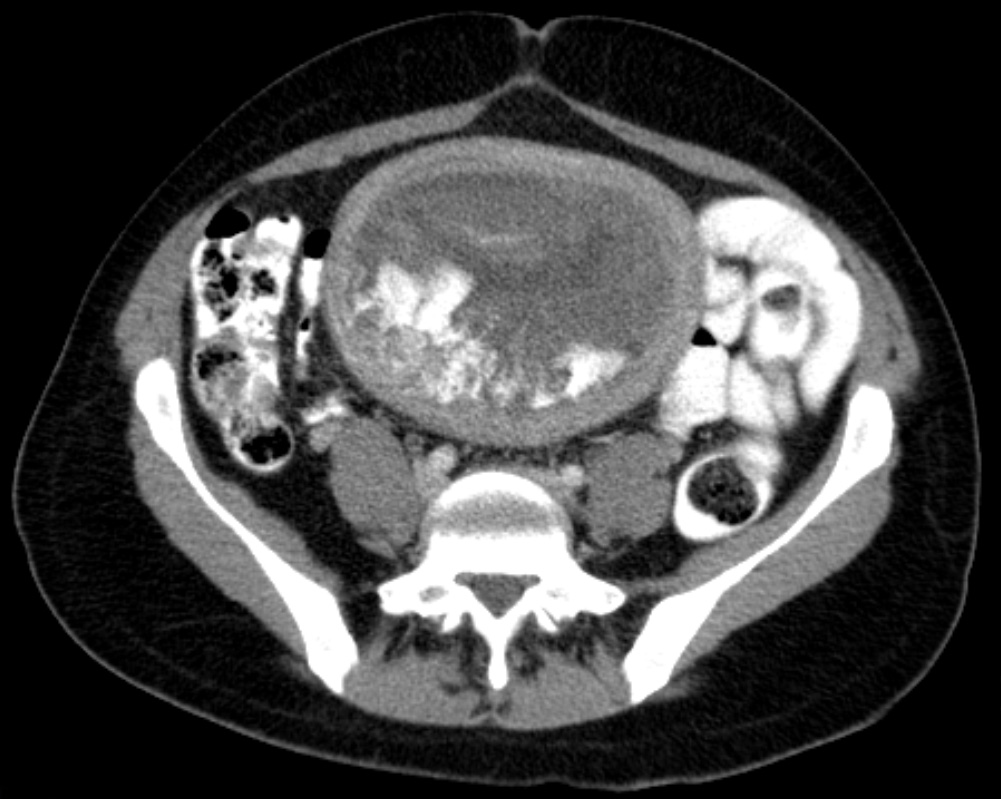 Gravidez molar: entenda por que ela ocorre e o que fazer