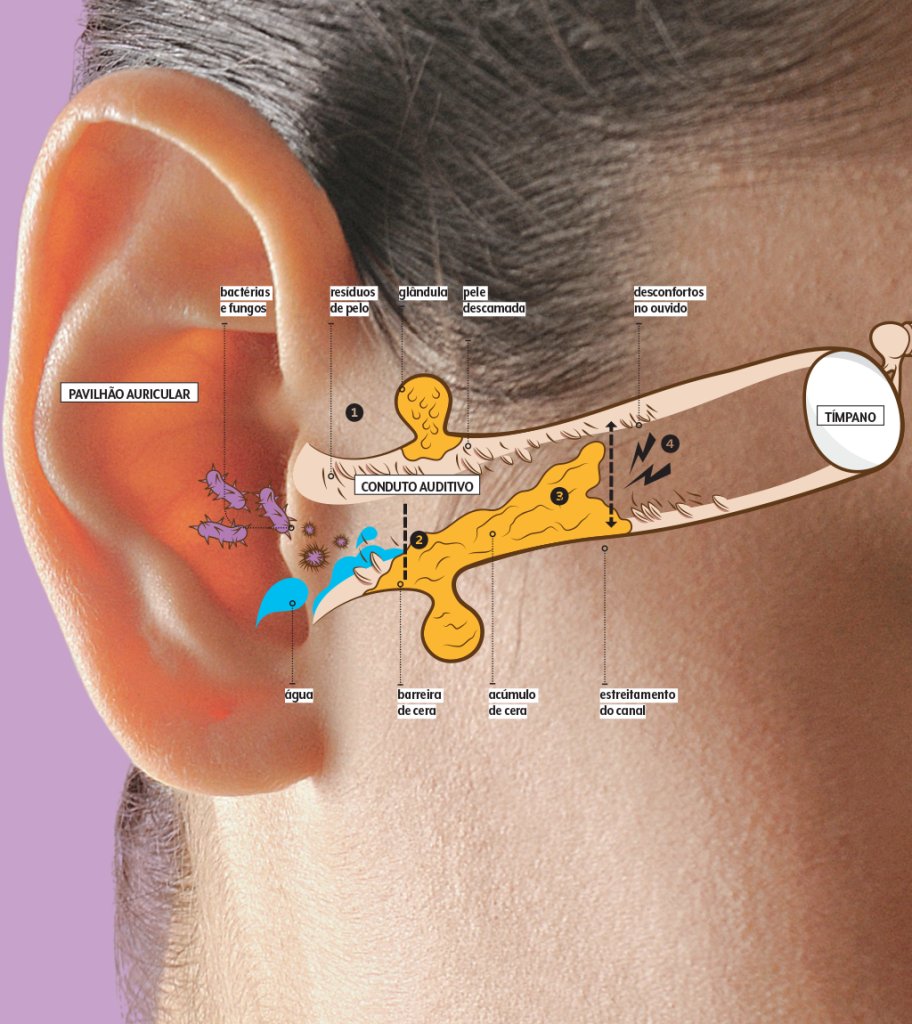 cera-de-ouvido-como-se-forma