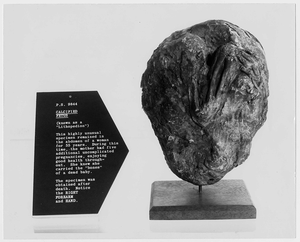 Litopedia: quando ocorre a calcificação do feto?