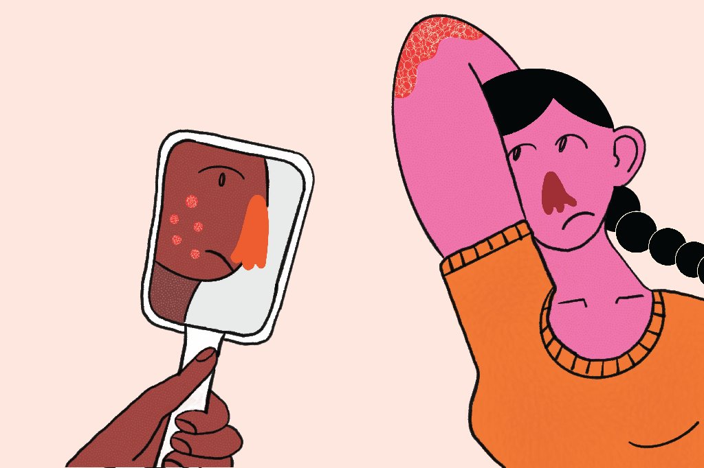 saude-medicina-dermatologia-pele-psoriase-acne