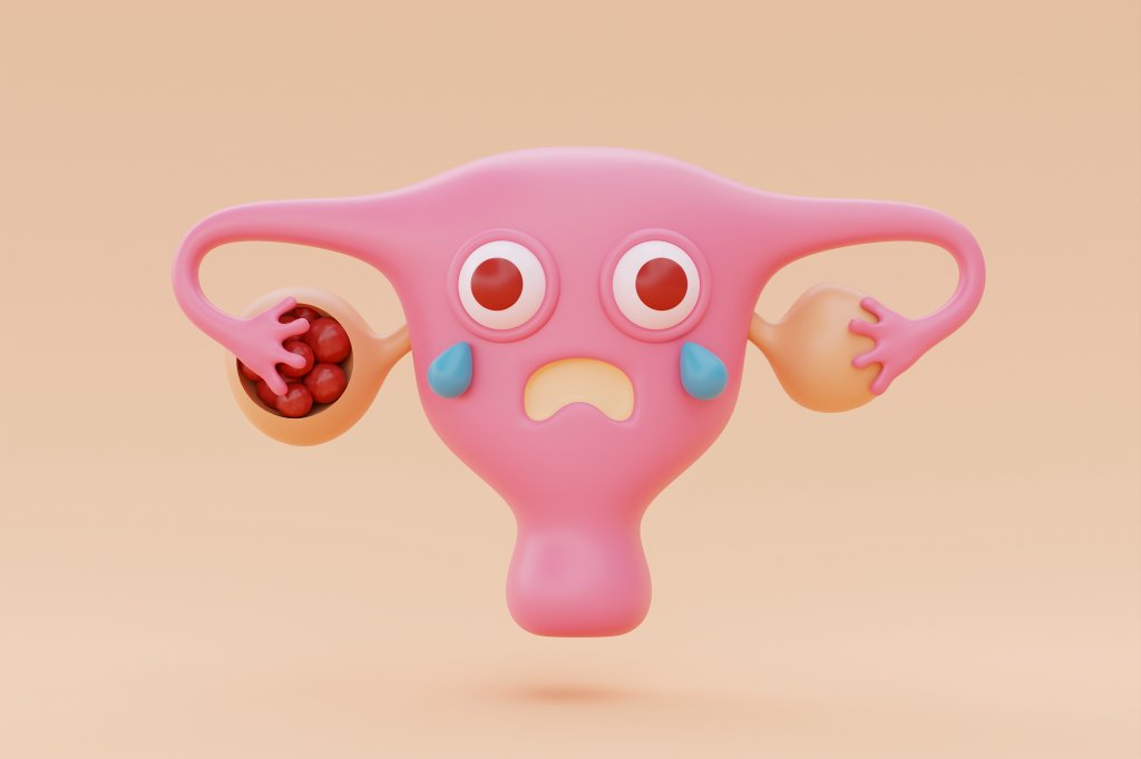 De acne a infertilidade: 5 doenças associadas à síndrome do ovário policístico