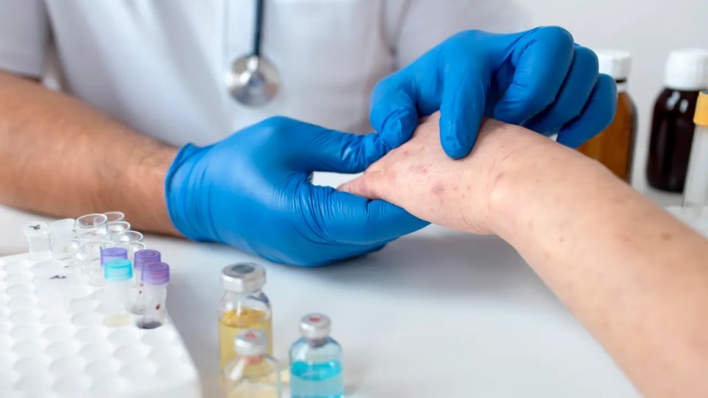 Brasil se aproxima de 150 casos de mpox em 2026; veja os estados com aumento